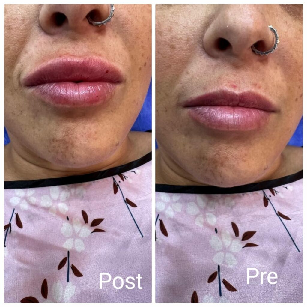 فيلر تكبير للشفايف